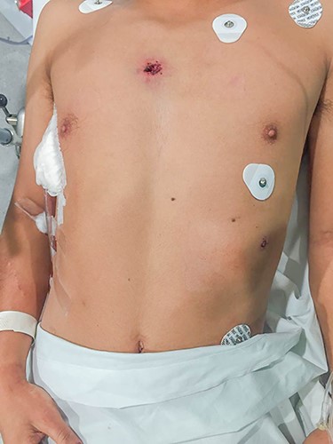 Patient upon arrival; two gunshot wounds are visible at the anterior and left thorax.