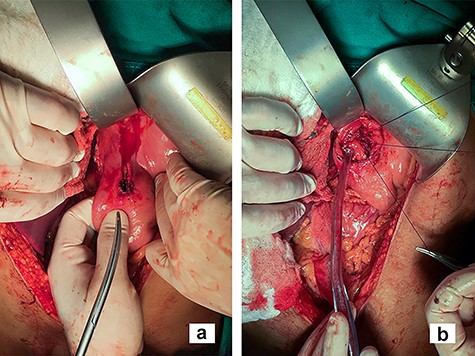 Transgastric approach; in the image, the closure of the GEJ injury is done through an anterior gastrotomy (b) made by expanding the perforating lesion in the stomach anterior wall (a).