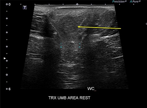 Abdominal wall ultrasound showing the one parietal peritoneal lipoma in the hernia sac (yellow arrow) and the 2 cm hernia neck (A-A).