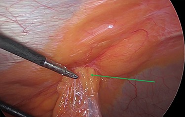 Laparoscopic view of the incarcerated omentum in the umbilical hernia (green arrow).