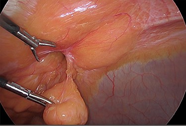 Reduction of the first peritoneal lipoma (green arrow) into the peritoneal cavity.