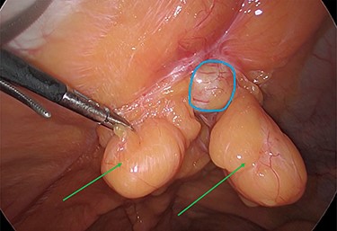The two peritoneal lipomas (green arrows) and the visible umbilical hernia neck (blue circle). Intracorporeal suturing of the hernia neck (green arrow) and closure of the hernial defect.