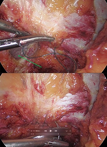 (a and b) Intracorporeal suturing of the hernia neck (green arrow) and closure of the hernial defect.