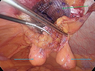 Preperitoneal mesh insertion (green arrow) and visible parietal peritoneal lipomas (blue arrows).