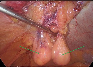 Mesh reperitonealization and parietal peritoneal lipomas in situ (green arrows).