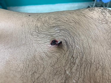 A stab wound of ~3 cm is described, at the lumbar portion of the patient’s spine, with a knife blade projecting from the wound. No active hemorrhage was seen.