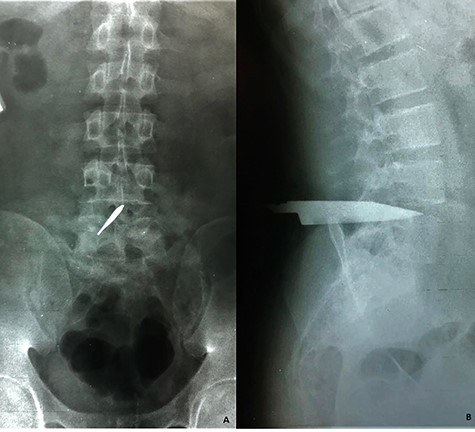 Lumbosacral radiographs were obtained revealing a foreign object compatible with a knife blade. (A) Anteroposterior view reveals the object placed within the L4–L5 intervertebral space involving the medullary canal and (B) lateral view shows the object that travels form posterior to anterior up to the L4–L5 intervertebral disc. No evidence of vertebral fractures nor free air were evidenced.