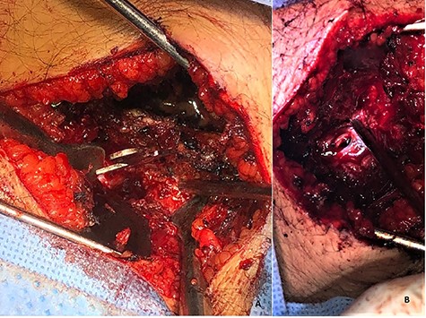 A right-sided L4–L5 laminectomy was performed for a total extraction of the knife blade. (A) Knife blade placed at the L4–L5 intervertebral space, at the right side from the spinous process and (B) shows the total extraction of the knife blade.