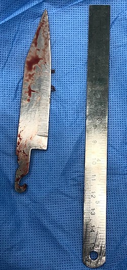 A 12-cm stainless steel blade was extracted.