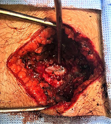 Primary closure of dural tear.