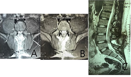A standard postoperative magnetic resonance imaging. (A–B) coronal T2 images show a posterior cumulus of fluid that seems to connect the epidural space with the subcutaneous tissue, at the L4–L5 space, related to the laminectomized level. (C) Sagital T2 image demonstrating a posterior cumulus of fluid at the L4–L5 space; no changes in the L4–L5 disc compared with adjacent levels, and scar tissue is visible within the dural sac. The image is highly suspicious of cerebrospinal fluid leakage; the origin of the leakage whether from the anterior or posterior surface of the dural sac is not clear.