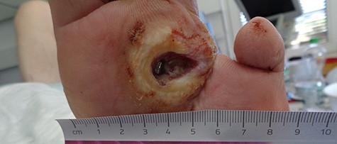 Infected ulcer and osteomyelitis of metatarsal bone II (probe to bone positive).