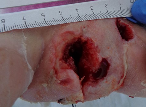After admission a trans-metatarsal amputation of dig. II was conducted, wound was left open.