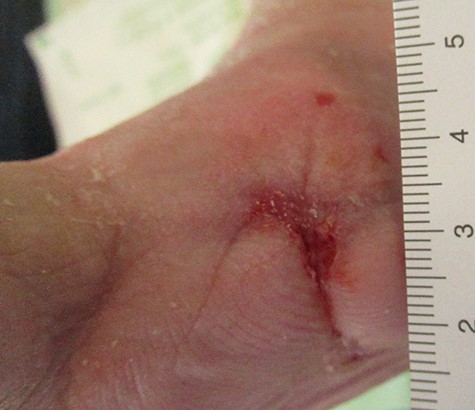 Wound 6 weeks after trans-metatarsal amputation of dig. II.