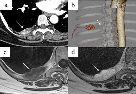 (a) Contrast-enhanced chest CT showing a right posterior mediastinal mass measuring 35 mm in diameter with heterogeneous contrast at the T7–T8 level, without extension into the spinal canal (arrow). (b) Three-dimensional reconstruction CT showing a feeding artery to the mass arising from the intercostal artery (arrow). (c, d) MRI showing low signal intensity on T1-weighted images but a bright signal on T2-weighted images (arrows). A high-signal area on T1-weighted MRI is suggestive of a fatty component inside the tumor. (c) T1-weighted image. (d) T2-weighted image.