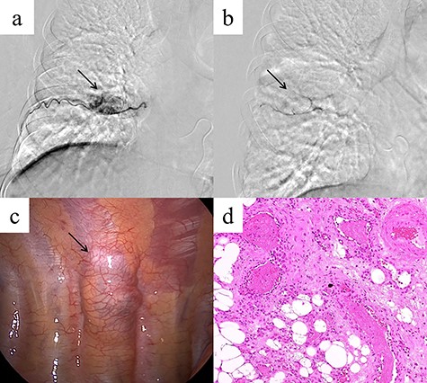 (a) Angiography showing a feeding vessel flowing into the mass from the right eighth intercostal artery and tumor staining (arrow). (b) Angiography after embolization showing disappearance of the tumor staining (arrow). (c) Intra-operatively, the mass is a soft tumor with a fatty component, but there is no invasion of the surrounding tissue (arrow). (d) Microscopic examination of the resected tumor reveals mature adipocytes and multiple small vessels (hematoxylin and eosin stain, original magnification ×200).