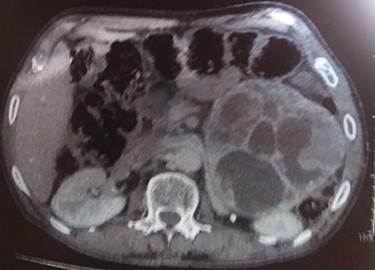 CT scan image showing left retroperitoneal cyst.