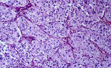 Histopathological section showing round to polygonal cells forming a zellballen.