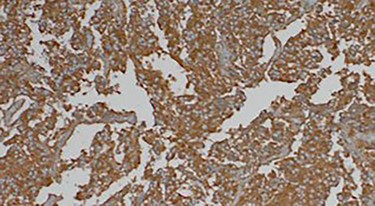 Immunohistochemically staining showing cells positive for chromogranin A.