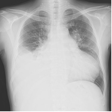 Plain chest radiograph at the time of admission.