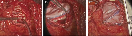 Intraoperative photograph; (A) The remnants of the pulmonary valve; (B, C). pulmonary valve replacement and patching.