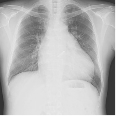 Plain chest radiograph of the first outpatient visit after discharge from the hospital.