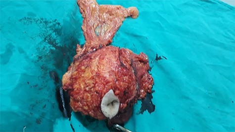 The mass after surgical removal. It consisted of the umbilicus, the tumor itself, a part of the omentum and intestines.