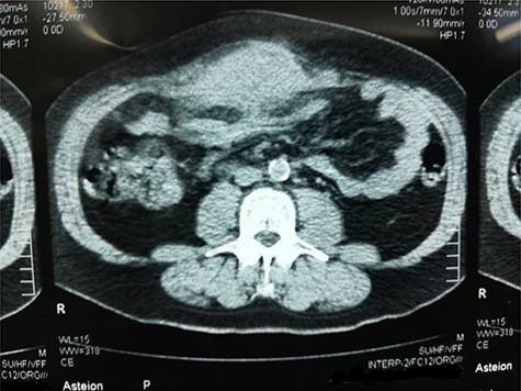 CT scan of the tumor as it shows infiltration to adjacent structures and attachment to the anterior abdominal wall.