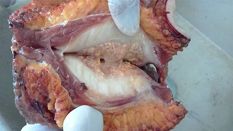 Gross anatomical view of the mass after dissection; note the jelly substance in the middle.