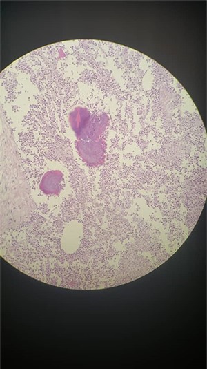 Microscopic evaluation of the tumor specimen.