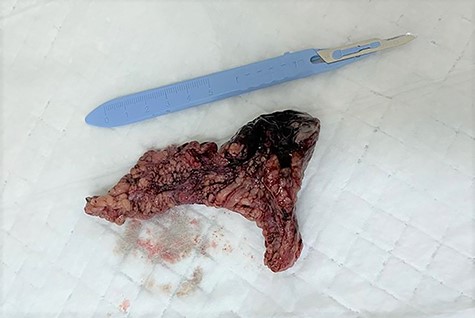 The excised inflamed edematous omentum with gangrene at its tip.