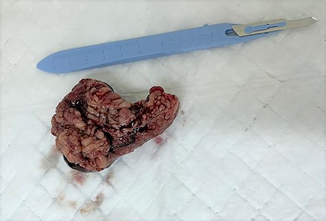 The excised inflamed edematous omentum with gangrene at its tip.