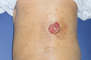 Preoperative photograph. An exophytic and cauliflower-like mass is seen on the back side of approximately T10 level.
