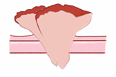 Illustration of the warty carcinoma. Two masses are pedunculated side by side on the back.