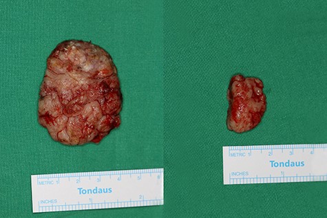 Gross specimen photographs after wide excision. Two masses are completely removed.