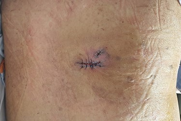 Immediate postoperative photograph. The surgical wound is primarily closed.