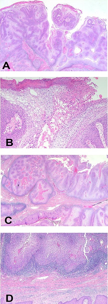 Histopathological images of the mass. (A) Arborizing papillomatosis with acanthosis (H&E, ×40), (B) parakeratosis of superficial layer, cytoplasmic vacuole and prominent fibrovascular cores (H&E, ×200), (C) broadly cancerous stromal invasion (H&E, ×10), (D) pleomorphic nuclei with prominent nucleoli and coarse chromatins (H&E, ×10). H&E, hematoxylin and eosin.
