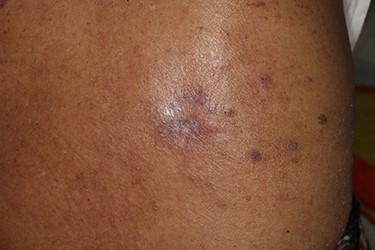 Six-month follow-up photograph. Any complication is not shown on the wound.