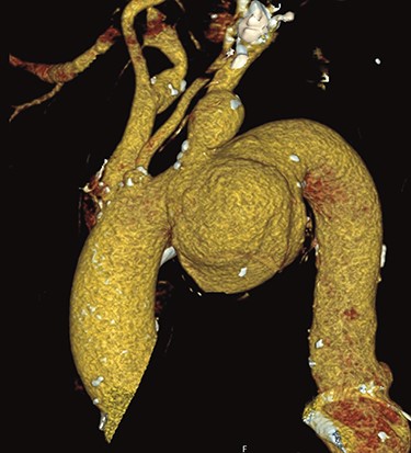 Preoperative CT reconstruction of the ascending and arch aneurysm.