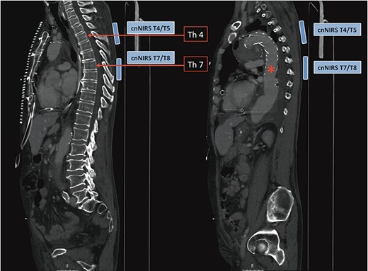 Computed tomography image demonstrating collateral network near-infrared spectroscopy (cnNIRS) optode placement for the frozen elephant trunk procedure. Optodes were placed at the high thoracic level T4/5 as reference and at mid-thoracic level T7/8 for oxygenation measurements during the procedure. (Red asterisk) Marking the distal part of the stented prosthesis.