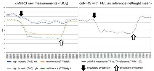 (Left) Collateral network near-infrared spectroscopy (cnNIRS) for high thoracic (T4/5) and mid-thoracic (T7/8) measurements during the procedure; (right) cnNIRS measurements as the ratio of mid-thoracic versus the high thoracic reference. (Black arrows) Start of circulatory arrest, (white arrows) perfusion start on cardiopulmonary bypass.