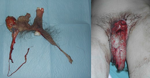 Avulsed right testis with skin shaft completely removed.