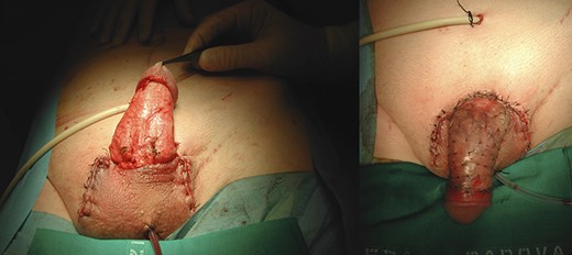 Skin graft to overlay the penile shaft through the quilting technique.