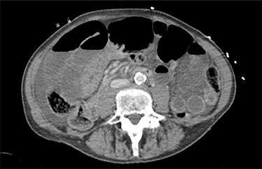The patients CT scan, axial slice showing distended loops of small bowel and free fluid.