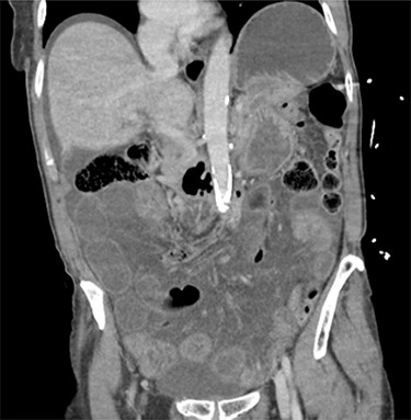 The patients CT scan, coronal slice.