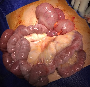 Photo taken at laparotomy demonstrating small bowel and mesentery congested with chyle.