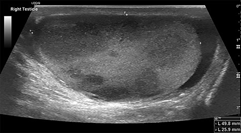 Testicular ultrasound of the right testicle demonstrating multiple hypoechoic lesions—the largest measuring 3 cm.