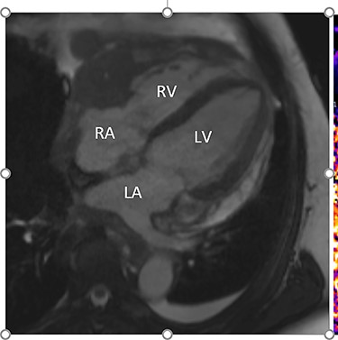 Cardiac MRI (transverse plane) demonstrating an enhancing lesion surrounding the chambers of the heart.