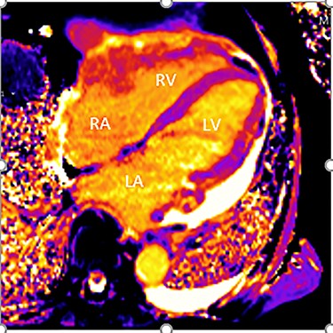 Cardiac MRI (transverse plane) demonstrating an enhancing lesion surrounding the chambers of the heart.