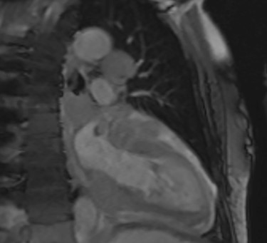Cardiac MRI (sagittal plane) showing the lesion encasing the aorta, pulmonary artery and all coronary arteries of the heart.